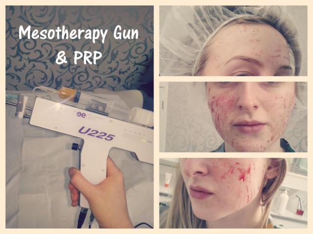 Mesotherapy & PRP Treatment 