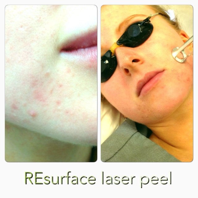 Before and during fractional laser resurfacing treatment
